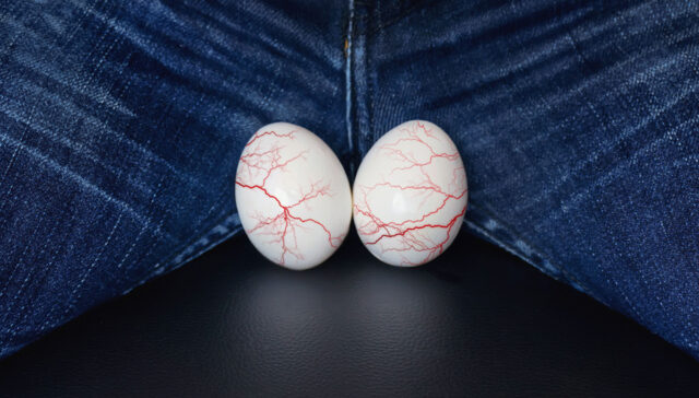 علاج دوالي الخصية