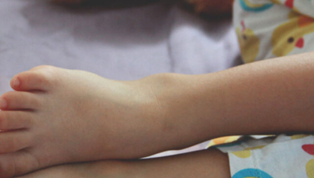 التبول اللاإرادي عند الأطفال