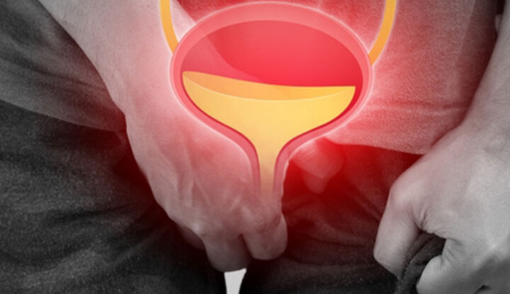 سلس البول الالحاحي