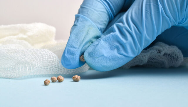 حصوات المثانة