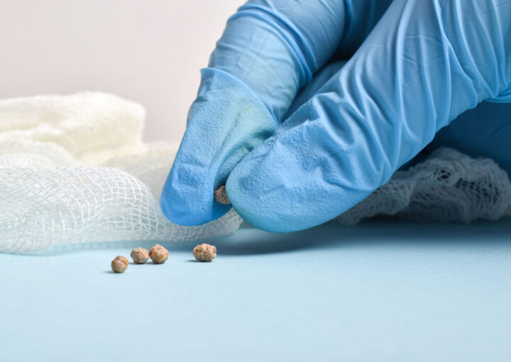 حصوات المثانة