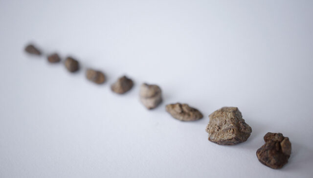 علاج حصوات المثانة