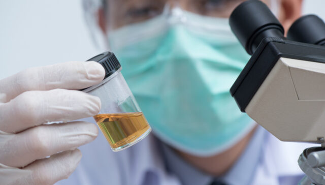 الصديد في البول