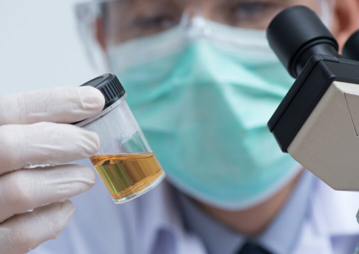 الصديد في البول