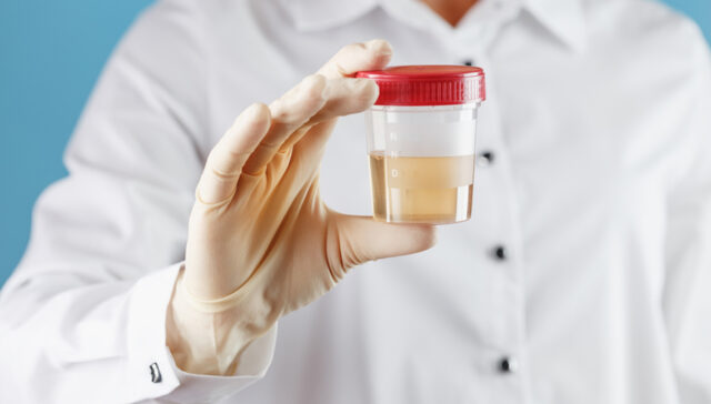 تحليل البول