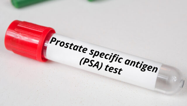 تحليل البروستاتا