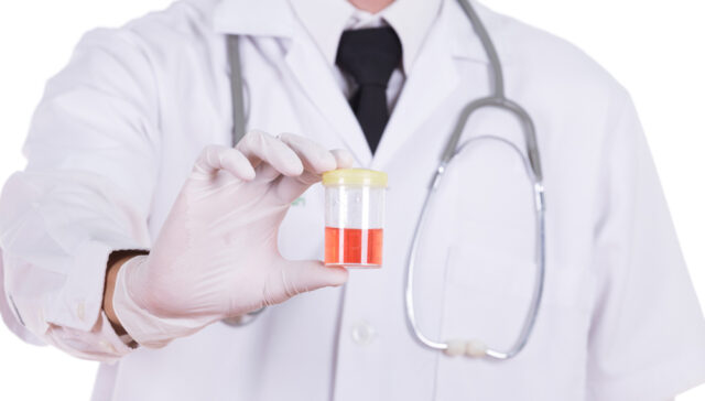 أسباب وجود دم في البول