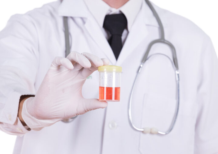 أسباب وجود دم في البول