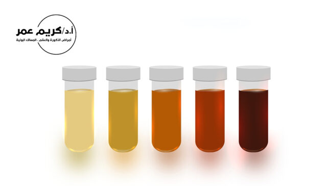 أسباب تغير لون البول