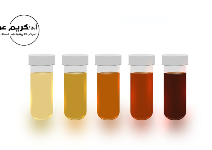 أسباب تغير لون البول