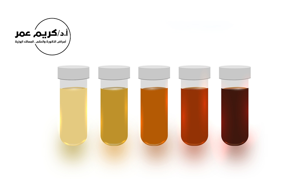 أسباب تغير لون البول